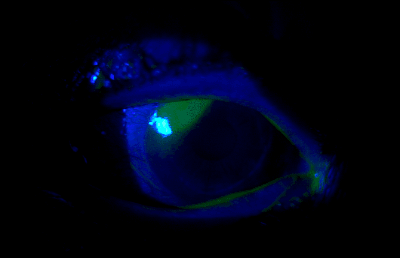 corneal abrasion.png